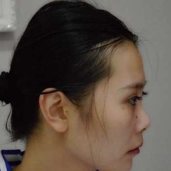 尹宏宇隆鼻案例，鼻子变好看了，一切都顺利了！